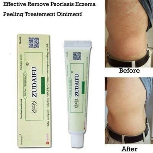 Natural Dermatitis Eczematoid Eczema Ointment Treatment Psoriasis
